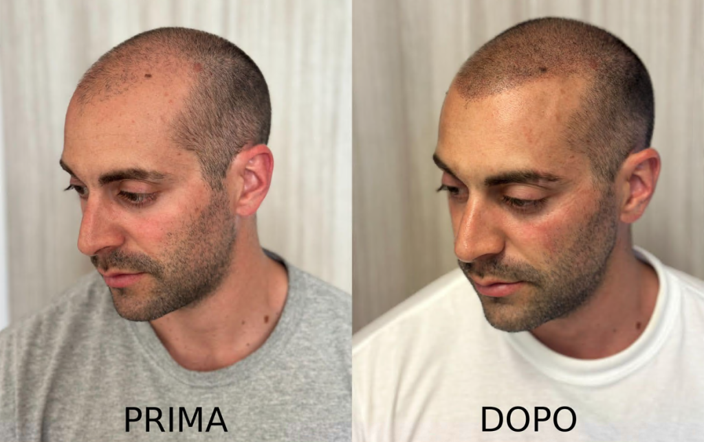 Dalla bellezza al benessere: Luce racconta il potere invisibile della tricopigmentazione